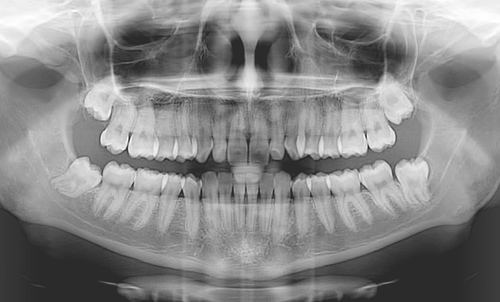  nervo alveolare con la Cone-Beam 3D