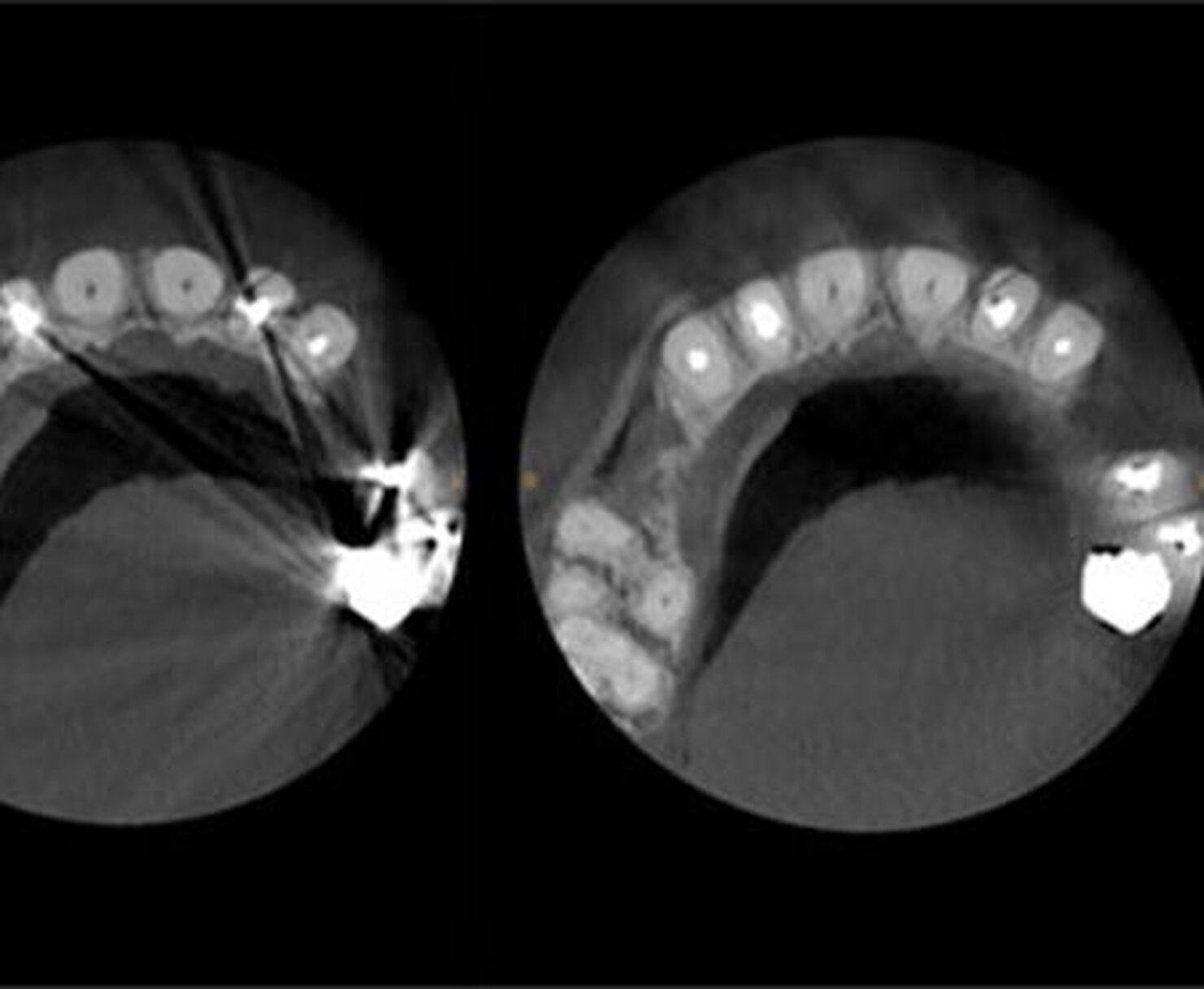 CS MAR (Metal Artifact Reduction)