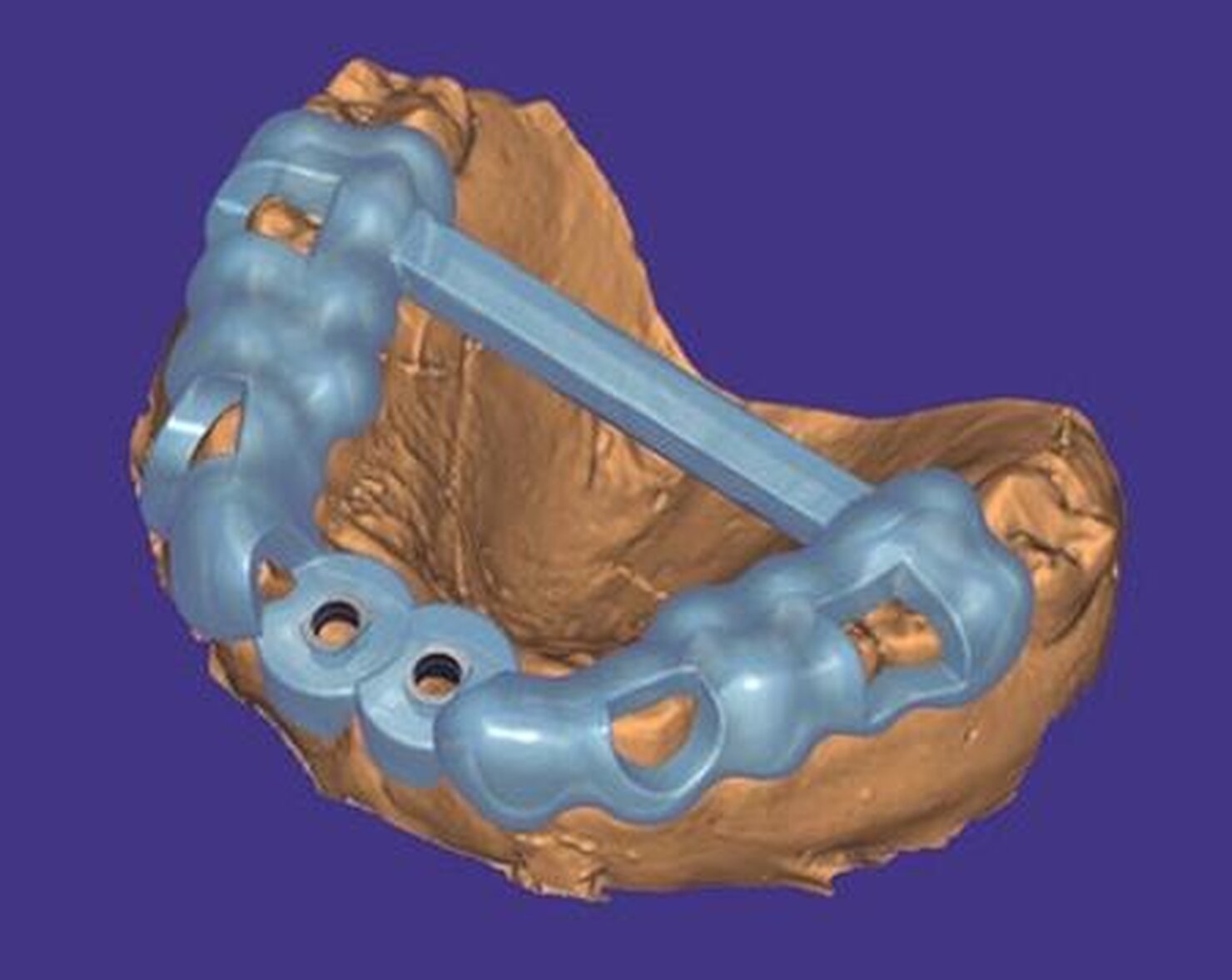 Guide chirurgiche in-house