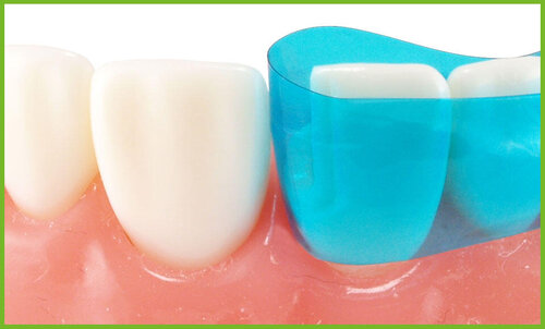  Restauri adesivi diretti nei settori anteriori