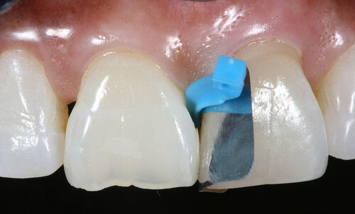 Restauri dentali e &ldquo;triangoli neri&rdquo; nella regione anteriore