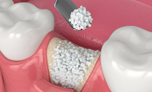 Rigenerazione Ossea Guidata 