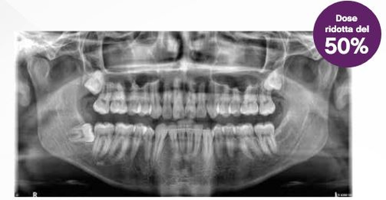 Imaging panoramico low dose
