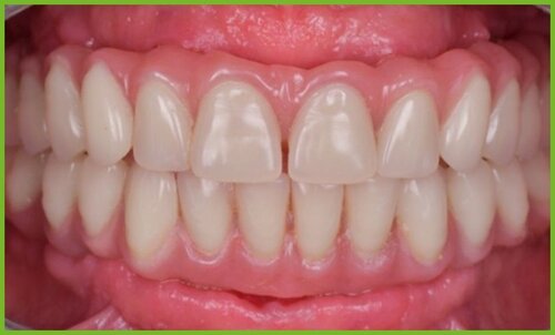 Dalla scansione intraorale alla scansione facciale, il paziente digitale nella riabilitazione protesica 