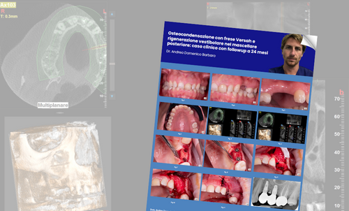 Osteocondensazione con frese Versah 