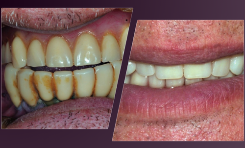 L'importanza dei contatti dentali nella protesi mobile ad appoggio mucoso