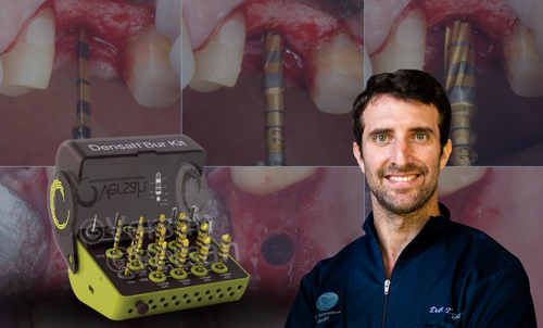 L'uso delle frese Versah per la osseodensificazione e la gestione del rialzo del seno mascellare per via transcrestale