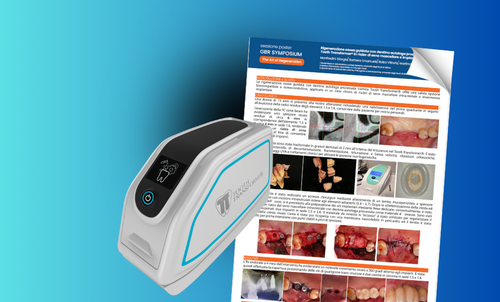 Rigenerazione ossea guidata con dentina autologa processata tramite Tooth Transformer&reg; in rialzo di seno mascellare e implantologia