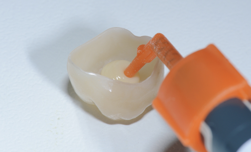 Cemento composito universale, cementazione autoadesiva di una corona , ricostruzione adesiva del moncone