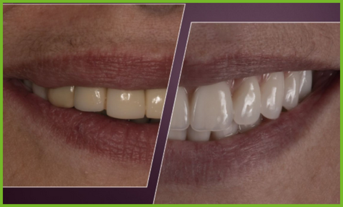 Riabilitazione estetica dei mascellari atrofici