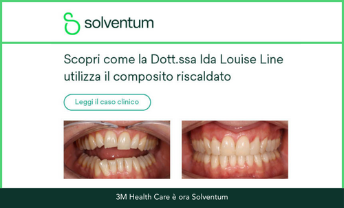Immagine di un caso clinico di restauro dentale con composito riscaldato della Dott.ssa Ida Louise Line