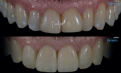 L&rsquo;impiego delle strisce abrasive diamantate Fitstrip durante la fase di preparazione dentaria ed adesivizzazione delle faccette in ceramica