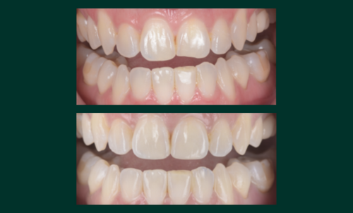Rifinitura estetica degli anteriori con Filtek&trade; Easy Match