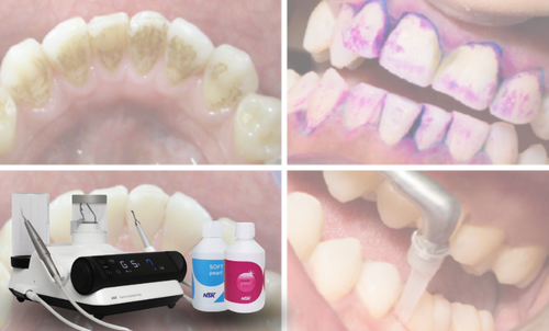Varios Combi Pro2 di NSK: la tecnologia che interpreta la filosofia della M.I.T. in odontoiatria