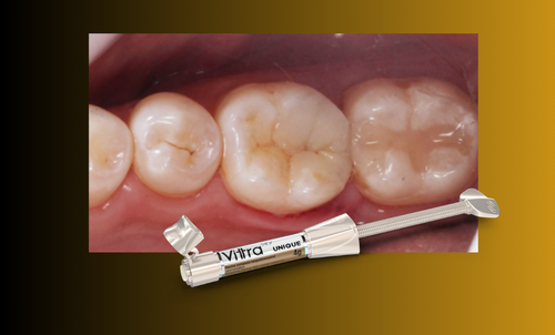 Trasformare un restauro insoddisfacente con la resina Vittra APS Unique