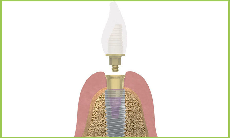 Protesi implantare avvitata o cementata