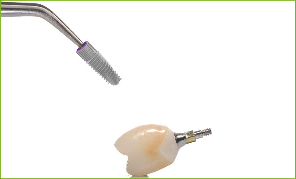 profilo di emergenza della protesi