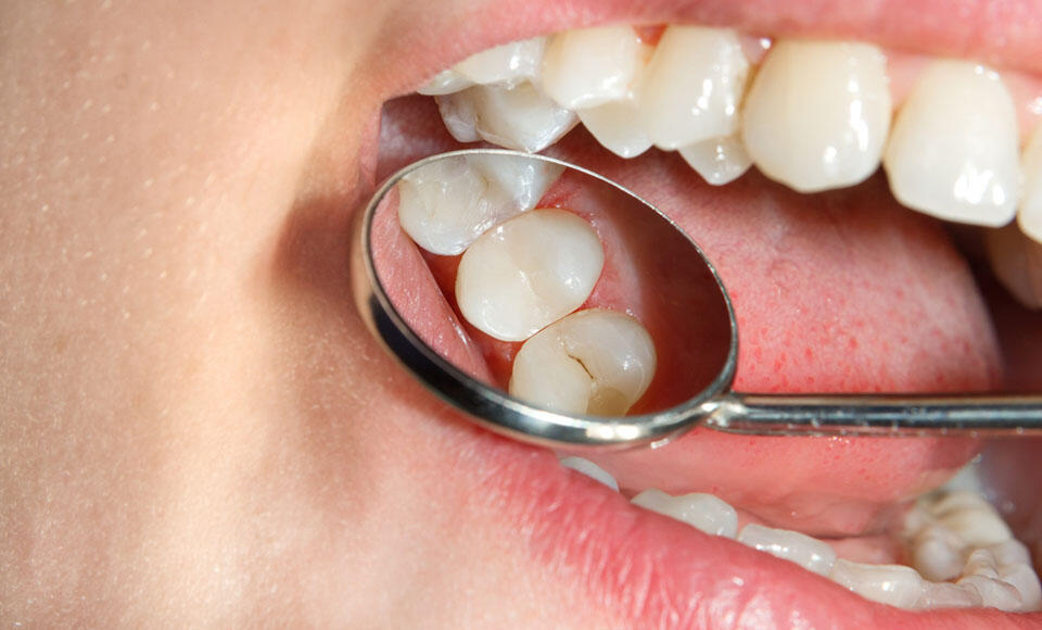 restauri endodontici 