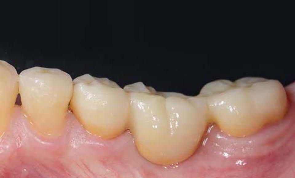 adesivi odontoiatria