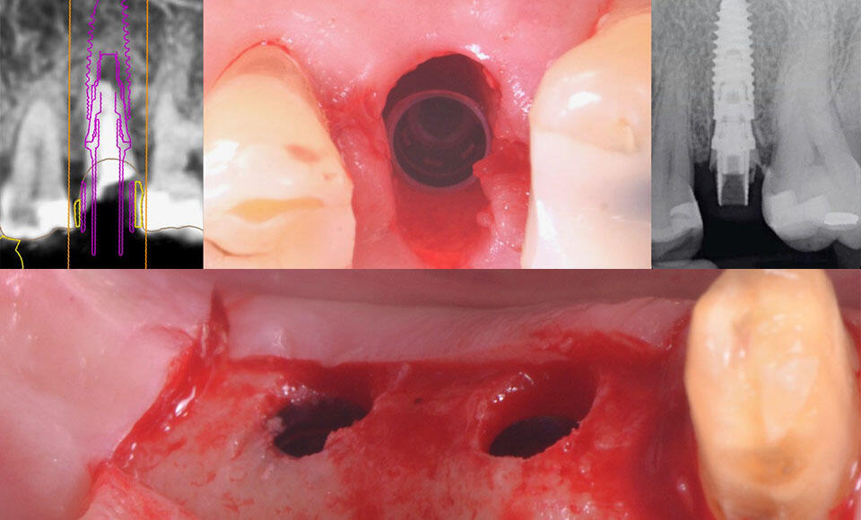 posizionamento implantare