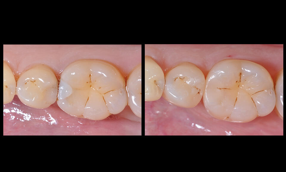 Restauri diretti posteriori