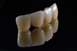 Manufatto protesico realizzato con tecnologia CAD/CAM