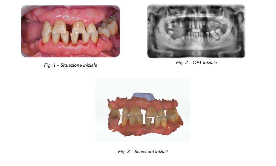 Dalla scansione intraorale alla scansione facciale