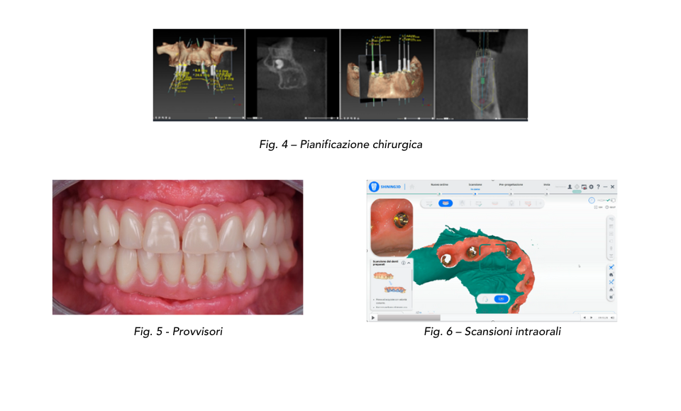 Dalla scansione intraorale alla scansione facciale