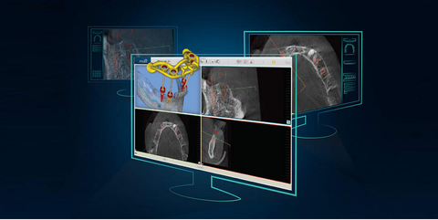 La realizzazione del caso implantare con strumenti digitali 