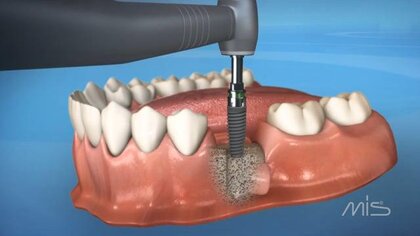 C1 - Implant Video