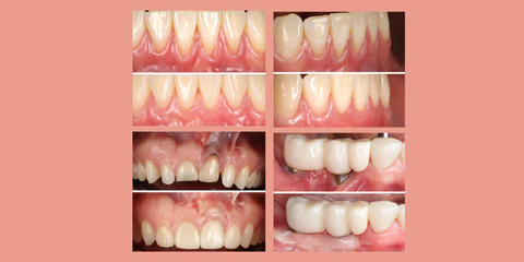 Tecniche semplificate per la copertura di recessioni su denti e impianti