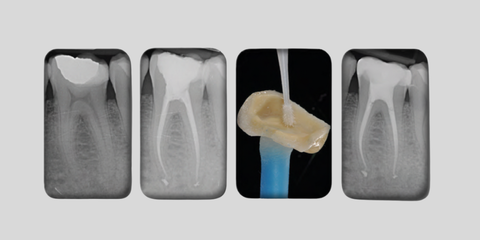 Approccio mini invasivo al trattamento endorestaurativo: nuovi paradigmi e nuovi strumenti