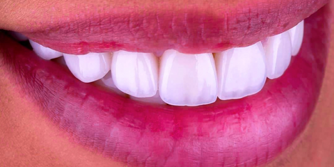 Faccette in ceramica: indicazioni, limiti e stato dell&rsquo;arte