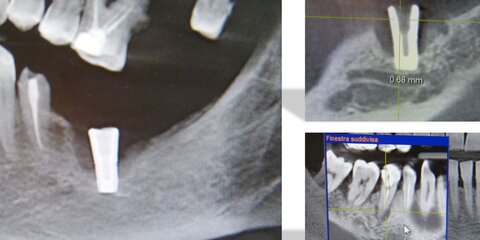Le potenzialita&rsquo; del dente naturale. Storia di una rivoluzione: analisi in vitro, valutazioni cliniche ed istologiche, vantaggi di un biomateriale autologo di origine dentale.