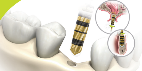 Osseodensificazione livello I - Ottimizza il sito, ottimizza il risultato