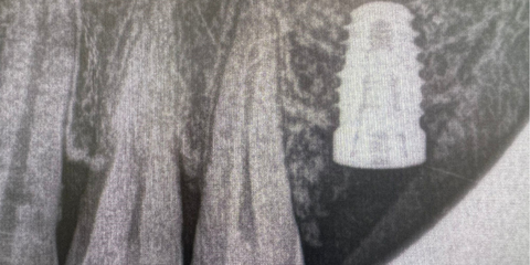 Principi di Osseodensificazione: come migliorare la qualit&agrave; del sito implantare