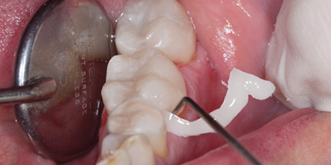 Protocolli di cementazione per semplificare la routine di tutti i giorni