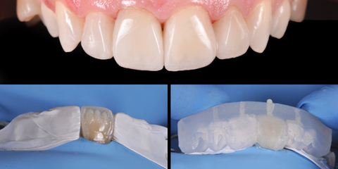 Flow Injection Technique: la soluzione pi&ugrave; semplice per veneering diretto