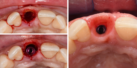 Estetica immediata in implantologia - Mastering the Socket Shield Technique