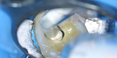 Applicazioni cliniche del Biodentine Xp e del Bioroot Flow