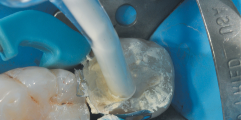 Mantenimento della vitalit&agrave; pulpare in Odontoiatria Restaurativa. Metodo Bio Bulk-fill