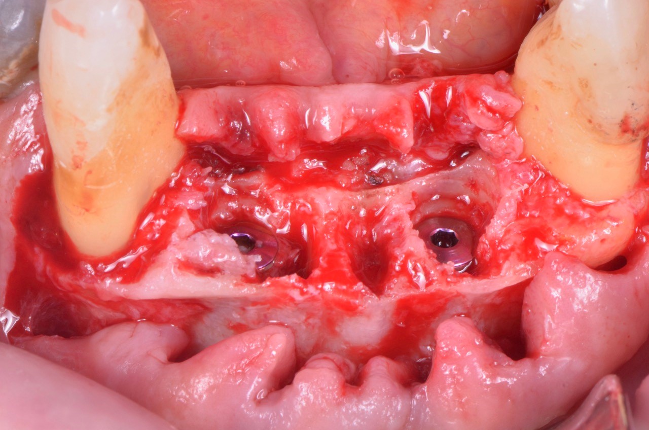 impianto-sottocrestale