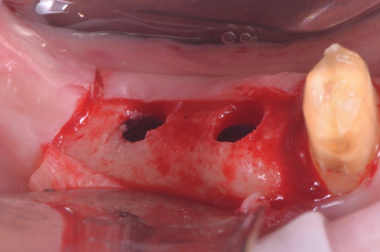 Posizionamento sub crestale di due V3