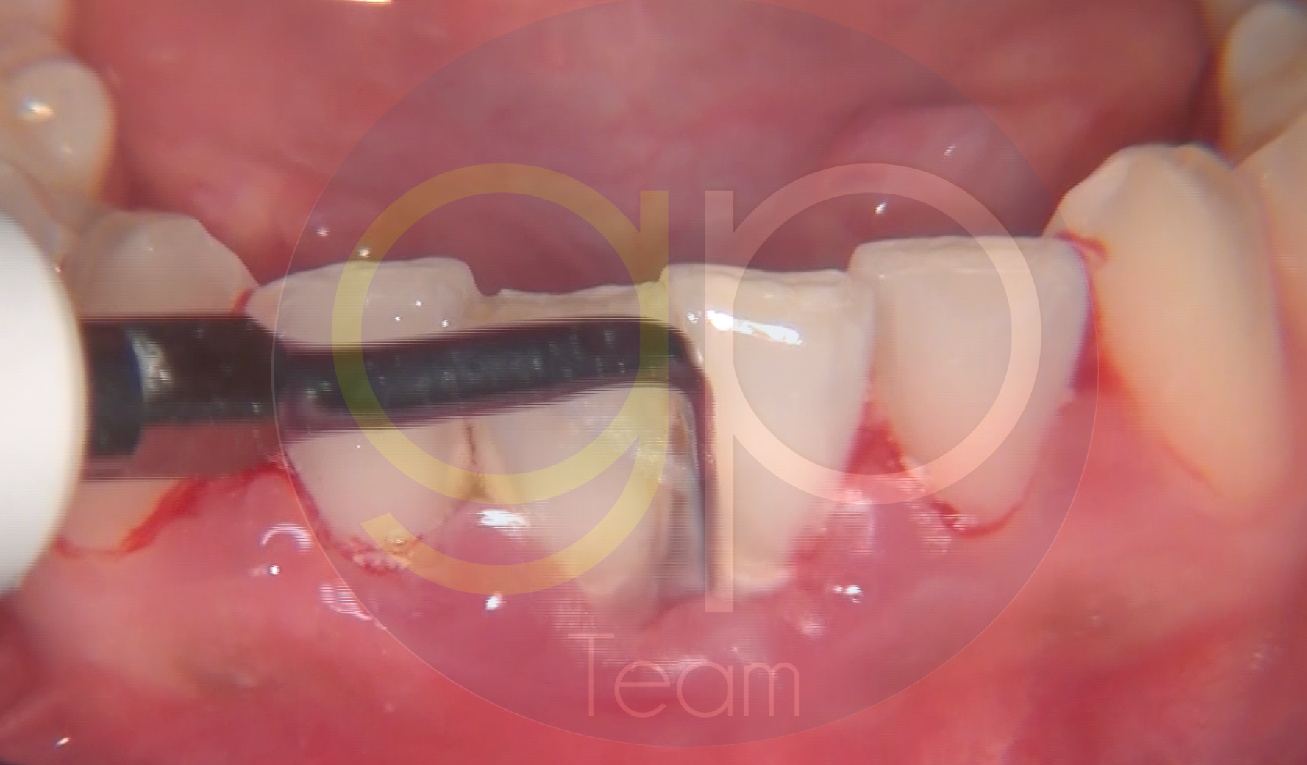 nsk-caso-varios-revello