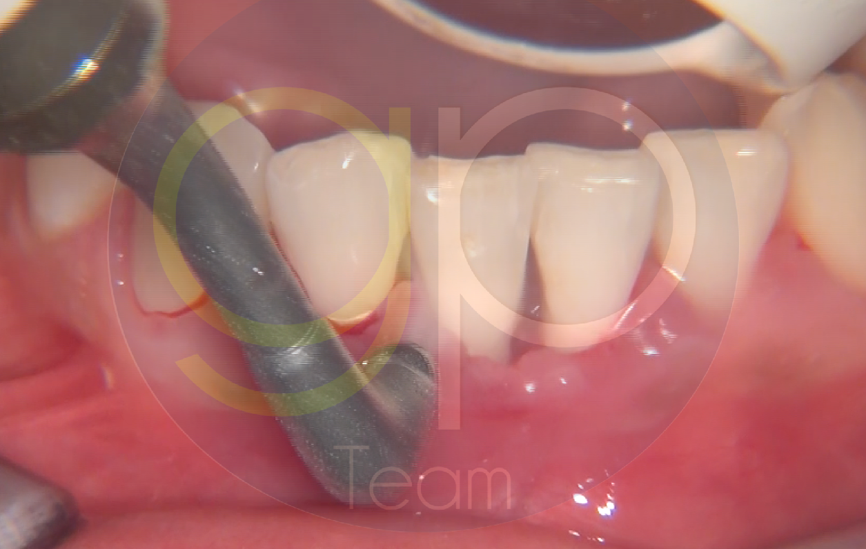 nsk-caso-varios-revello